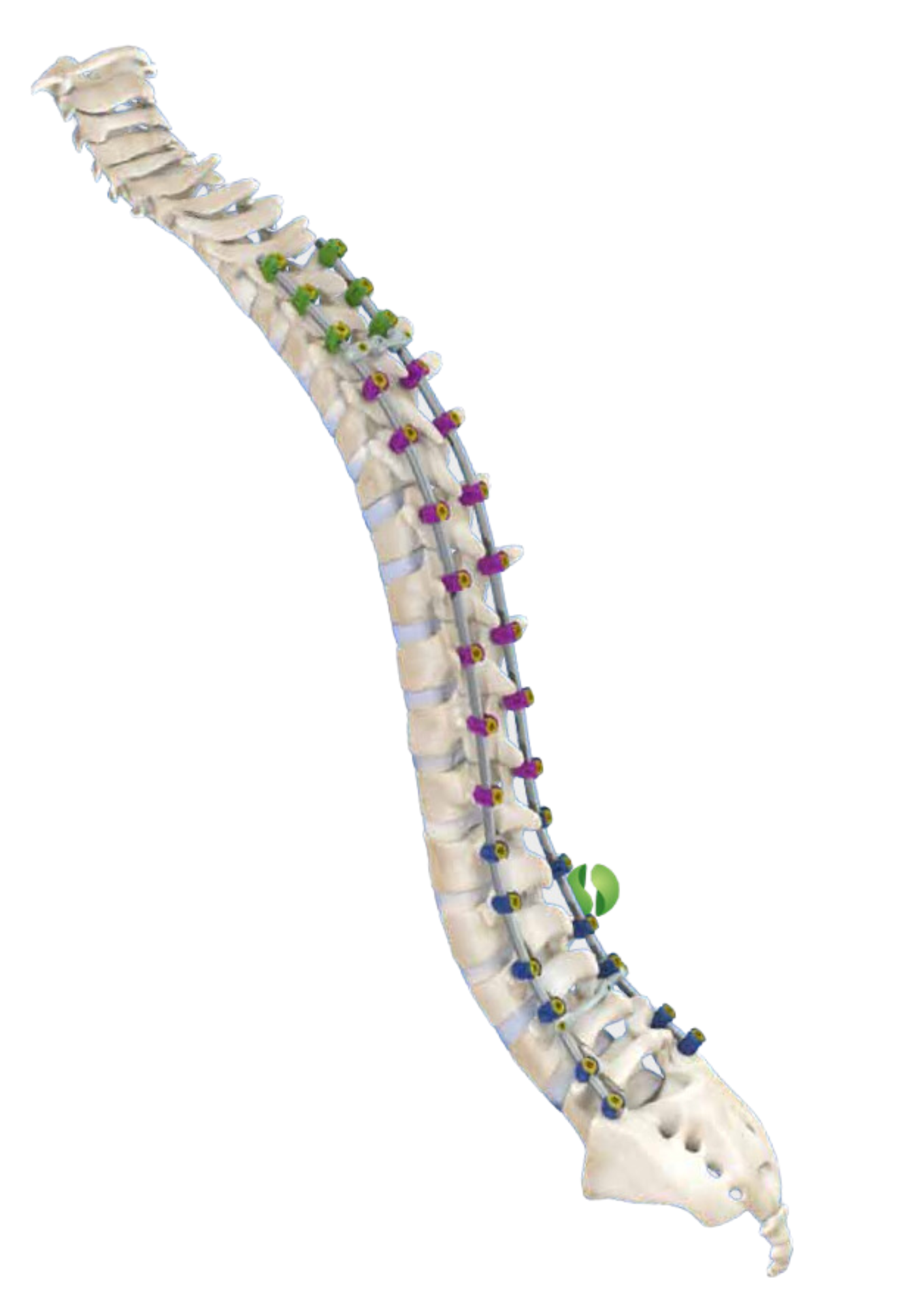 APEX-DL Spine System