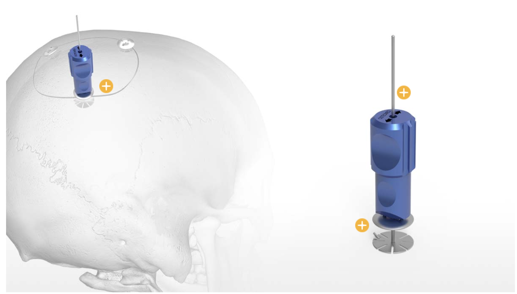 Cranial Clamp System