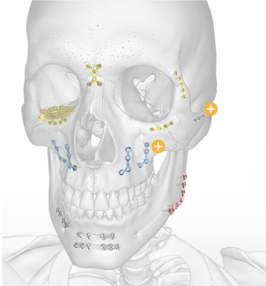 Craniomaxillofacial Plating System 