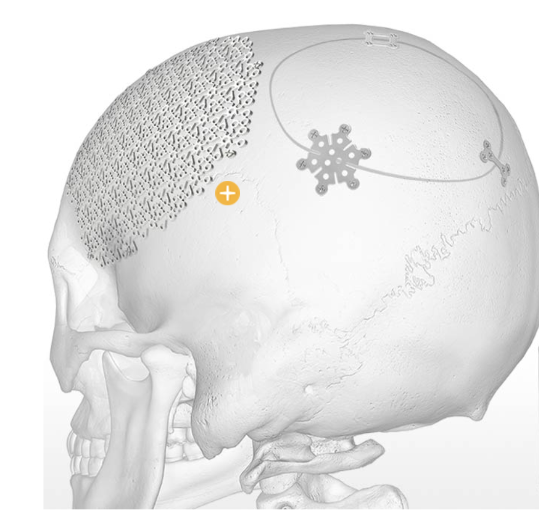 Neuro Plating System