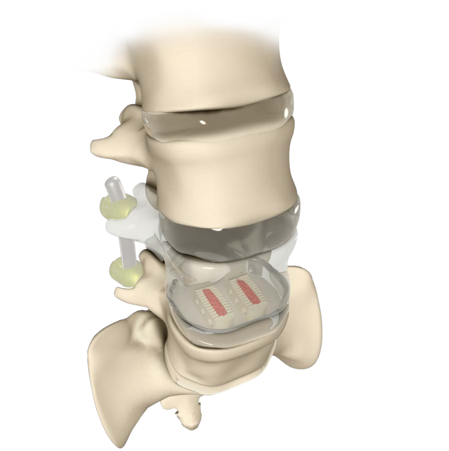 PLIF Cage System